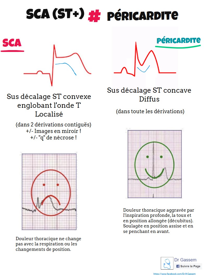 SCA vs Péricardite (à l'ECG)